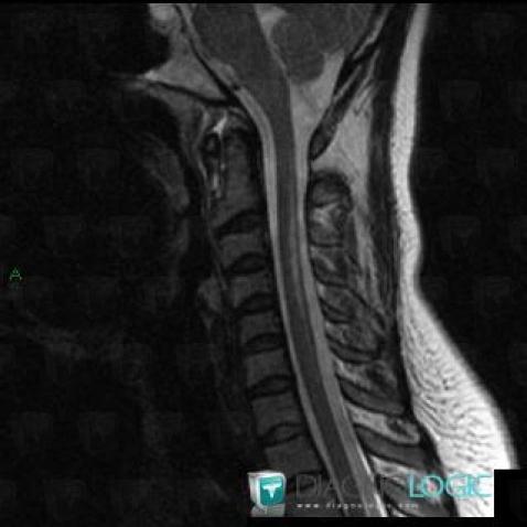 Subacute combined degeneration-the spinal cord, Spinal canal / Cord, MRI