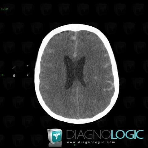 Subarachnoid hemorrhage, Cortico subcortical region, CT