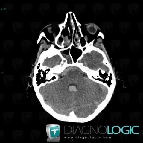 Subarachnoid hemorrhage, Infratentorial peri cerebral spaces, CT