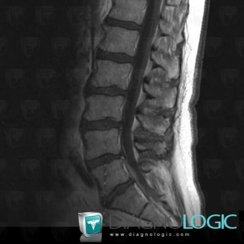 Subarachnoid hemorrhage, Spinal canal / Cord, MRI