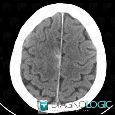 Subarachnoid hemorrhage, Supratentorial peri cerebral spaces, Cerebral falx / Midline, CT