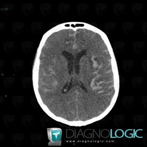 Subarachnoid hemorrhage, Supratentorial peri cerebral spaces, CT