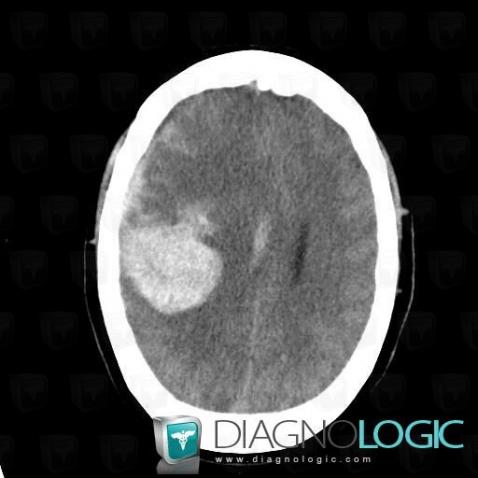 Subarachnoid hemorrhage, Supratentorial peri cerebral spaces, CT