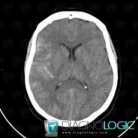 Subarachnoid hemorrhage, Supratentorial peri cerebral spaces, CT