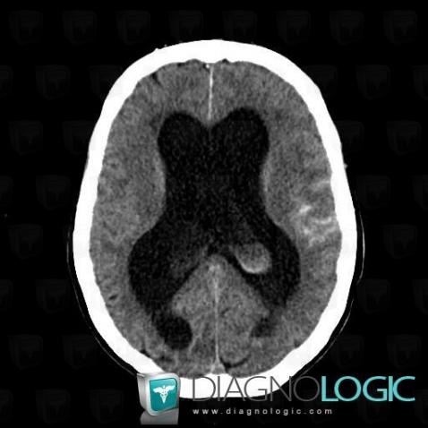 Subarachnoid hemorrhage, Supratentorial peri cerebral spaces, CT