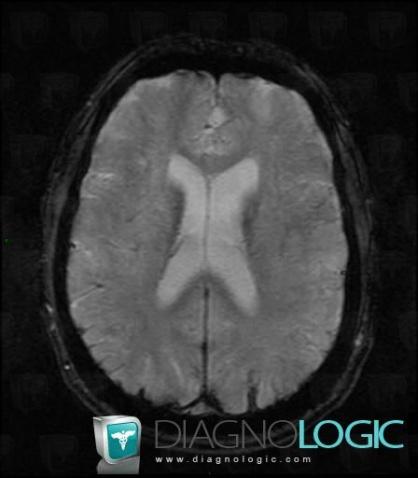 Subarachnoid hemorrhage, Supratentorial peri cerebral spaces, MRI