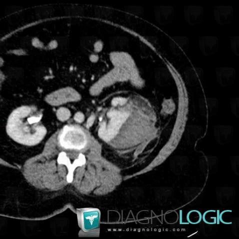 Subcapsular hematoma, Kidney, CT