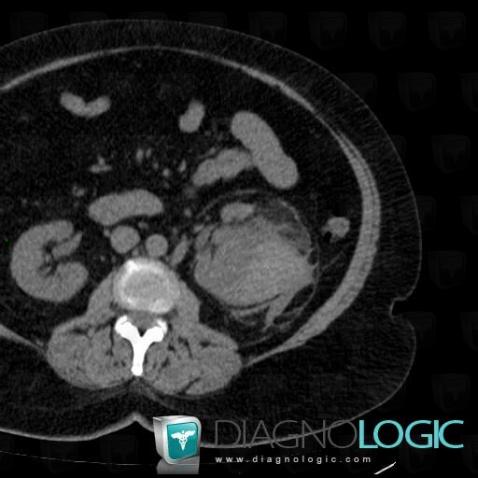 Subcapsular hematoma, Kidney, CT