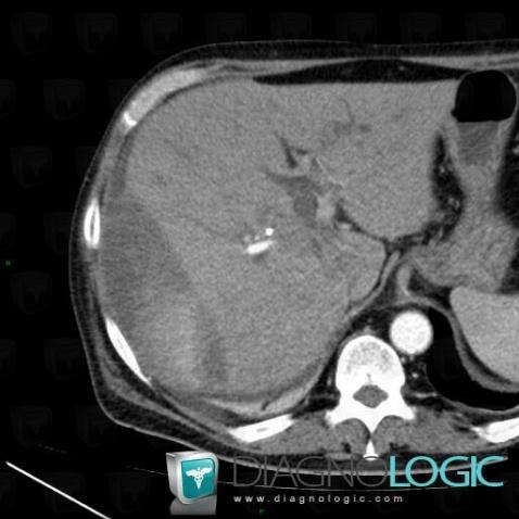 Subcapsular hematoma, Liver, CT
