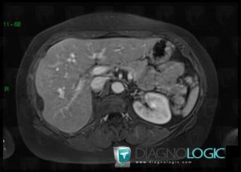 Subcapsular hematoma, Liver, MRI