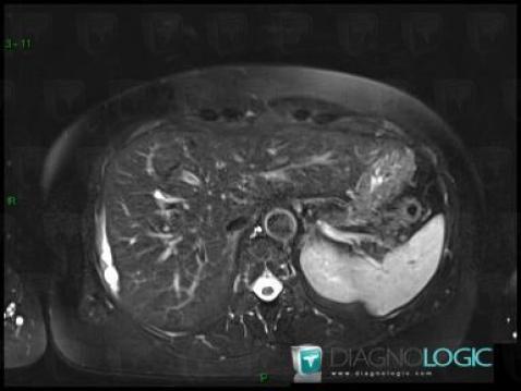 Subcapsular hematoma, Liver, MRI