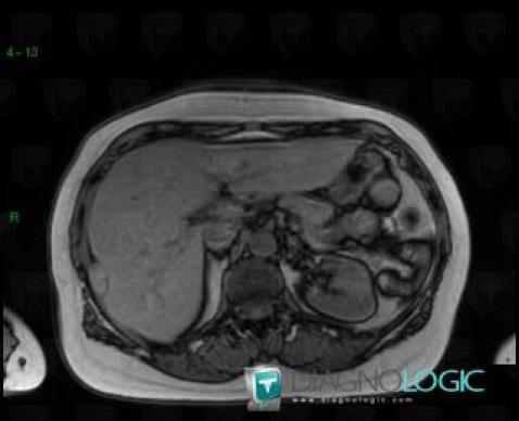 Subcapsular hematoma, Liver, MRI