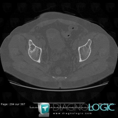 Subchondral cyst, Ilium, CT