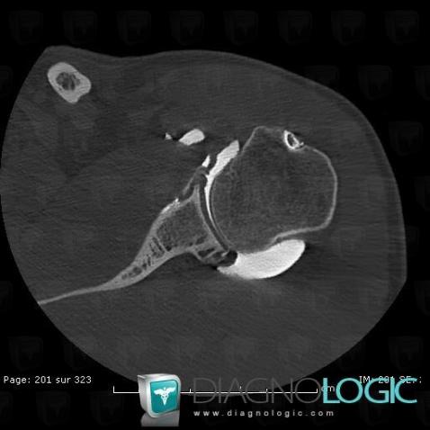 Subchondral cyst, Scapula, CT