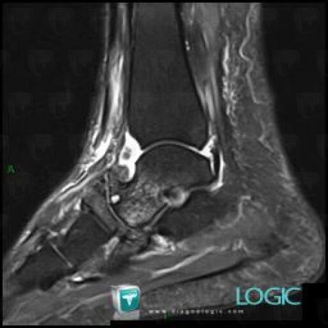 Subchondral cyst, Talus, MRI