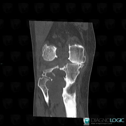 Subchondral cyst, Tibia - Proximal part, CT
