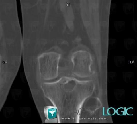 Subchondral cyst, Tibia - Proximal part, CT