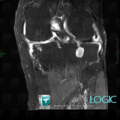 Subchondral cyst, Tibia - Proximal part, MRI