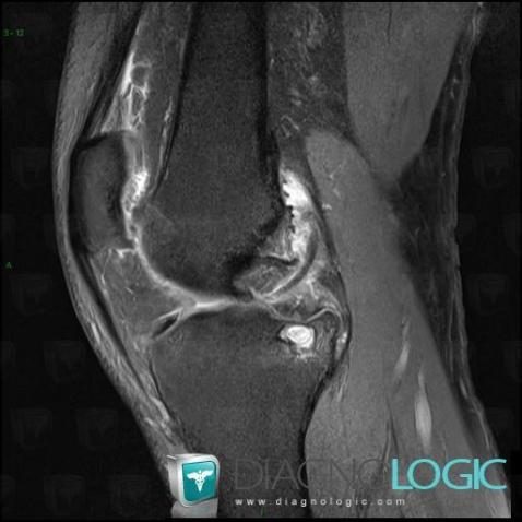 Subchondral cyst, Tibia - Proximal part, MRI