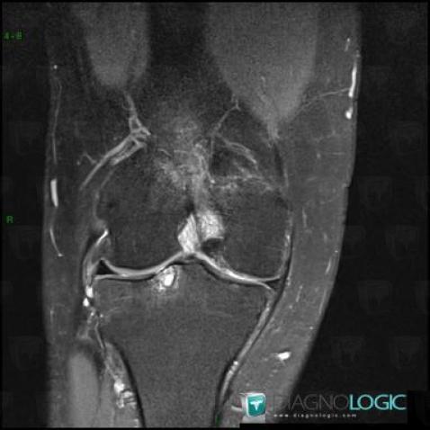 Radiology case : Subchondral cyst (MRI) - Diagnologic