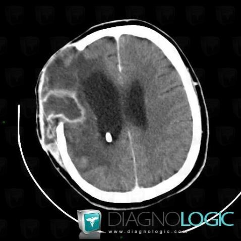 Subdural empyema, Supratentorial peri cerebral spaces, CT