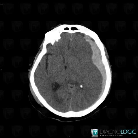 Subdural hematoma, Supratentorial peri cerebral spaces, CT