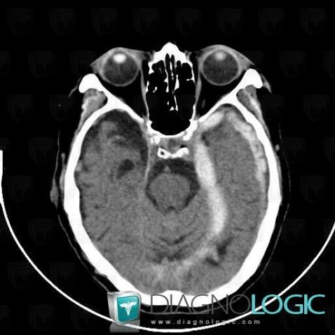Subdural hematoma, Supratentorial peri cerebral spaces, CT