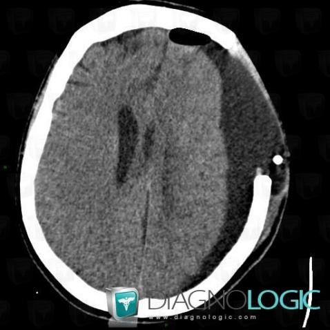 Subdural hygroma, Supratentorial peri cerebral spaces, CT