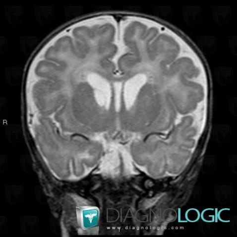 Subependymal cyst, Cerebral hemispheres, Ventricles / Periventricular region, MRI