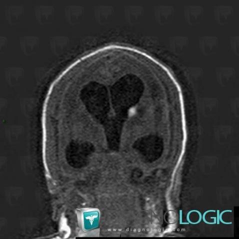 Subependymal hemorrhage, Ventricles / Periventricular region, MRI