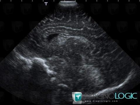 Subependymal hemorrhage, Ventricles / Periventricular region, US