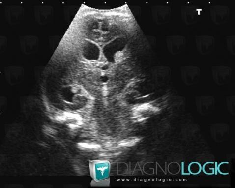 Subependymal hemorrhage, Ventricles / Periventricular region, US