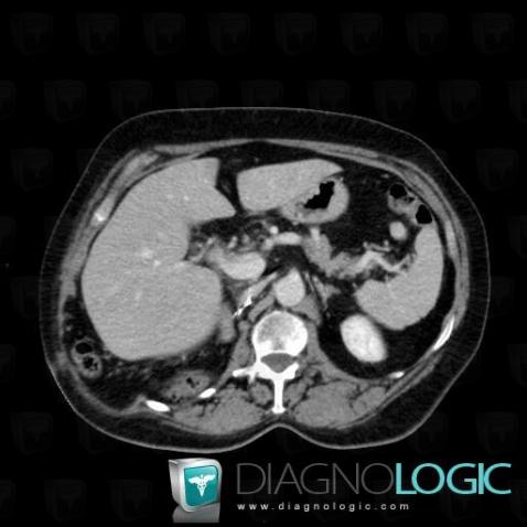 Superior lumbar hernia, Abdominal wall, CT