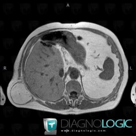 Superior lumbar hernia, Abdominal wall, MRI