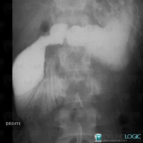 Superior mesenteric artery syndrome, Duodenum, X rays