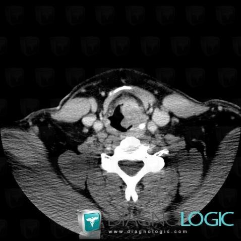 Supraglottic carcinoma, Larynx, CT