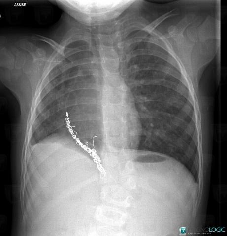 Syndrome-cimeterre, Parenchyme pulmonaire, Théorique