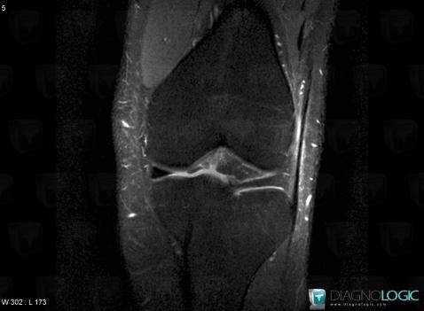 Cas Radiologie Syndrome De La Bandelette Ilio tibiale IRM Diagnologic