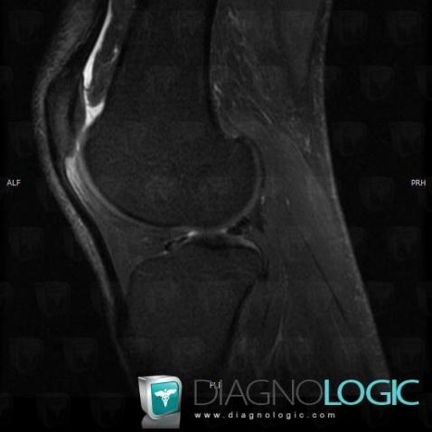 Syndrome-friction fémoro-patellaire, Tendon patellaire, Autres parties molles/nerfs - Genou, IRM