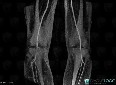 Syndrome-l artère poplitée piègée, Artères - Genou, IRM