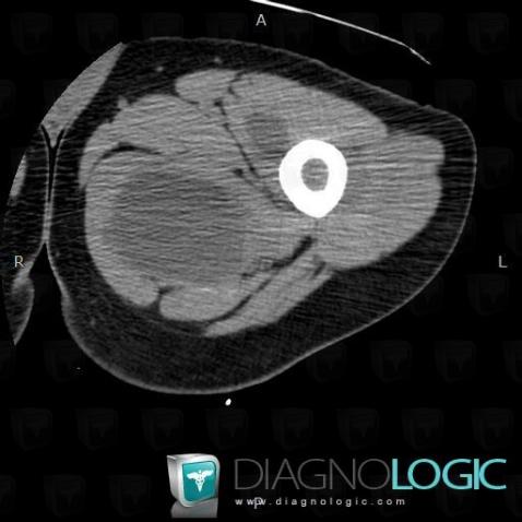 Syndrome-Mazabraud, Muscles - Cuisse, Scanner