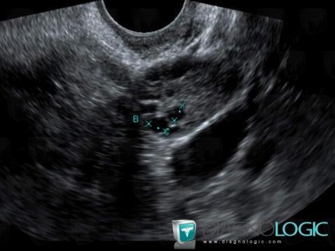 Syndrome-ovaires micropolykystiques, Annexe / Ovaire - trompe, Echographie