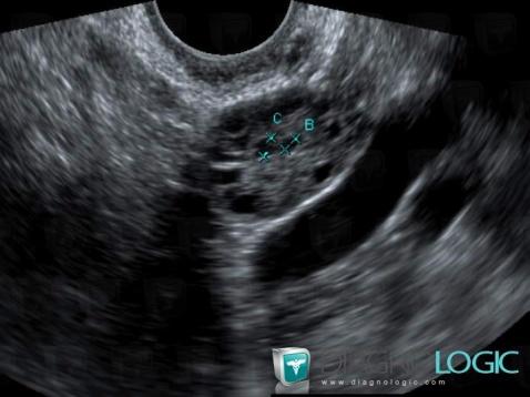 Cas Radiologie : Syndrome Des Ovaires Micropolykystiques (Echographie ...