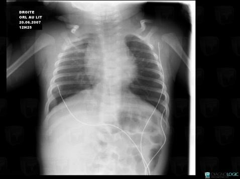 Syndrome-phaces, Sternum, Radio