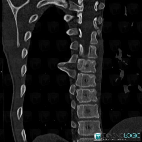 Synostosis, Ribs, CT