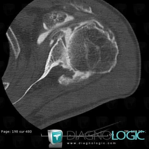 Synovial chondromatosis, Gleno humeral joint, CT