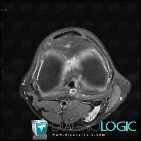 Synovial chondromatosis, Other soft tissues/nerves - Knee, MRI