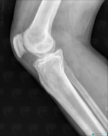 Synovial chondromatosis, Other soft tissues/nerves - Knee, X rays