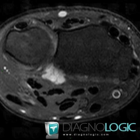 Synovial cyst, Distal radio ulnar joint, Other soft tissues/nerves - Wrist, MRI