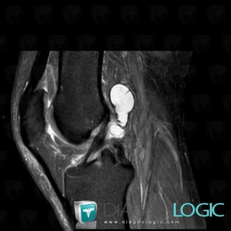 Synovial cyst, Femorotibial joints - Intercondylar notch, Other soft tissues/nerves - Knee, MRI